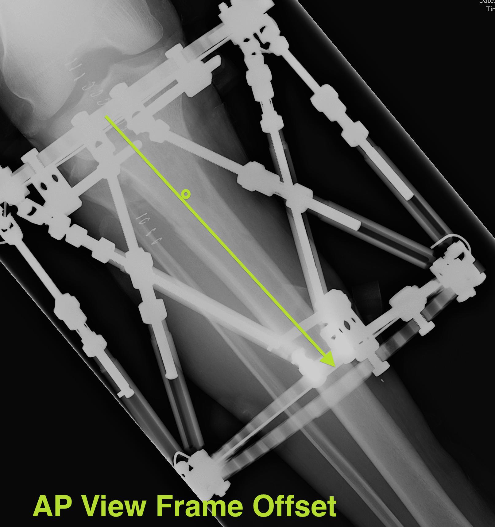 TSF AP View Frame Offset